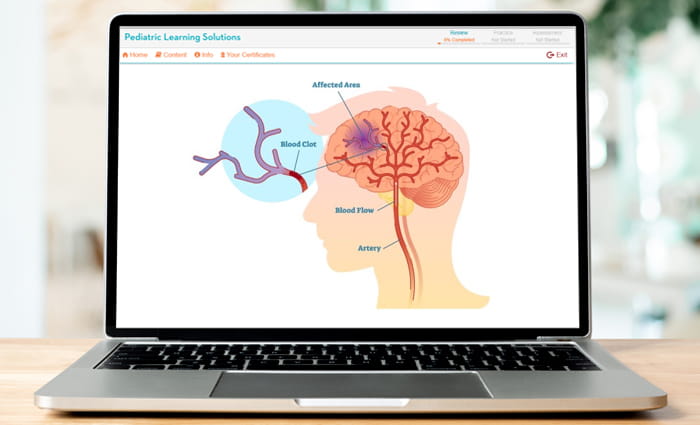 Pediatric Stroke Overview